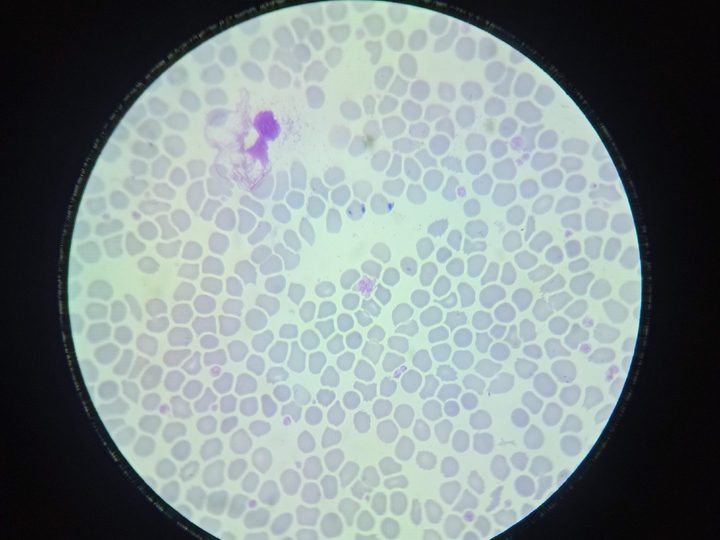 Blood smear, giant platelet and single normal-sized platelets