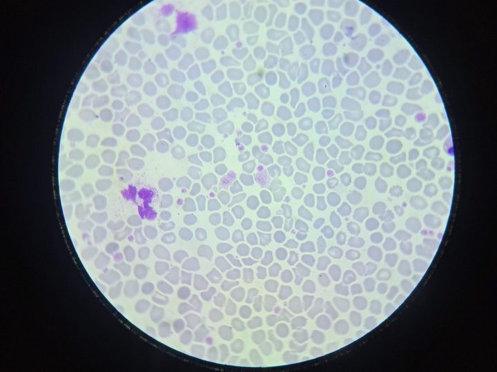 Blood smear, large platelet aggregate and macrothrombocytes among erythrocytes