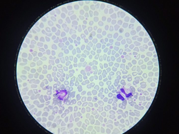 Blood smear, giant platelet in the center of the field of view and disrupted leukocytes