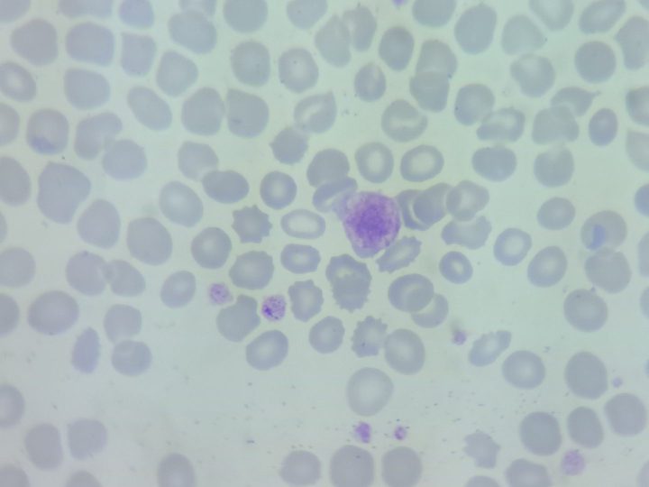 Blood smear, macrothrombocyte with abundant azurophilic granulation in the center
