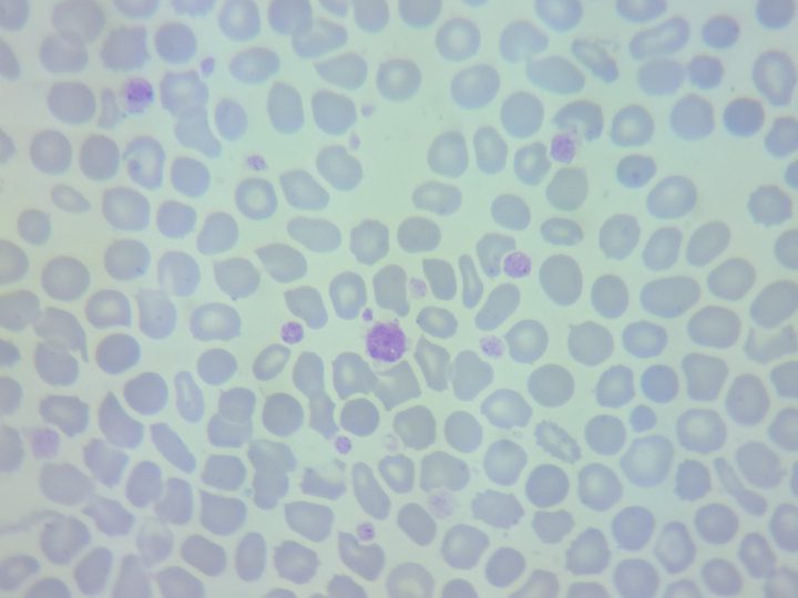 Blood smear, large macrothrombocyte the size of an erythrocyte among poikilocytes