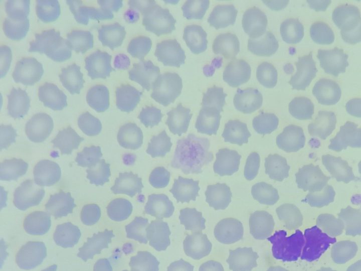 Blood smear, giant platelet with scalloped edges against a background of echinocytes