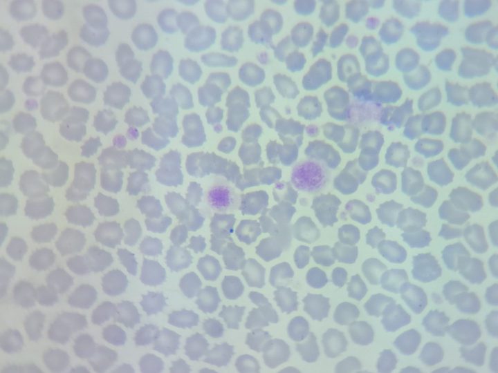 Blood smear, two large macrothrombocytes in the field of view of a light microscope