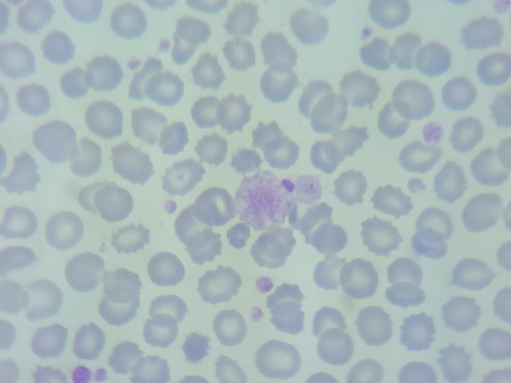 Blood smear, giant platelet with distinct granulomere and clear hyalomere