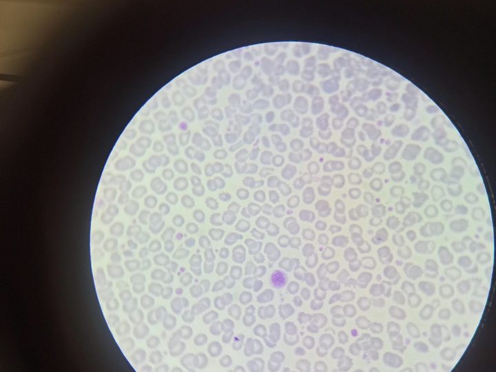 Peripheral blood smear, isolated macrothrombocyte in the center of the field of view