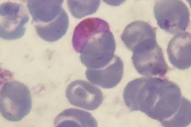 Plasmodium falciparum Malaria Parasite in a Blood Smear