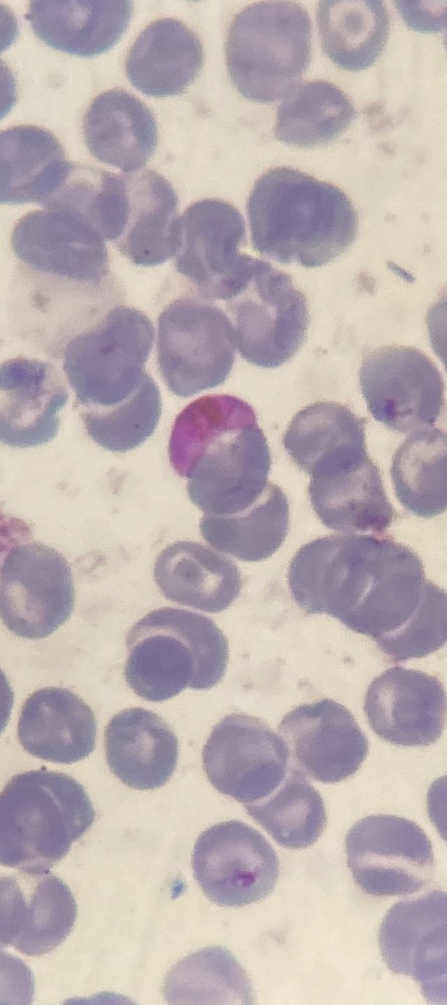 Малярийный плазмодий Plasmodium falciparum в мазке крови