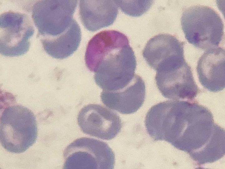 Blood smear, erythrocyte with malaria plasmodium under immersion microscopy