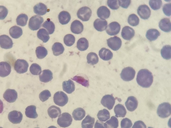 Blood smear, crescent-shaped Plasmodium falciparum gametocyte in the center of the field of view