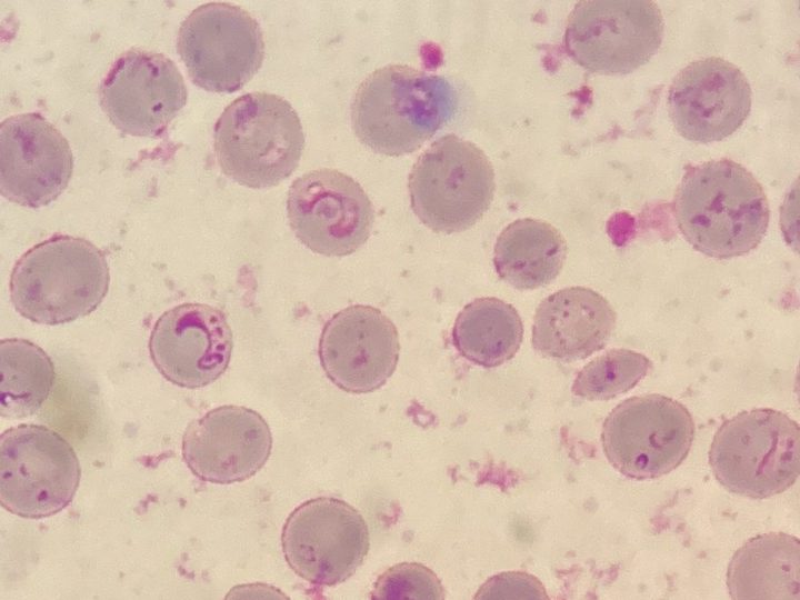 Blood smear, ring-form Plasmodium falciparum trophozoites in erythrocytes