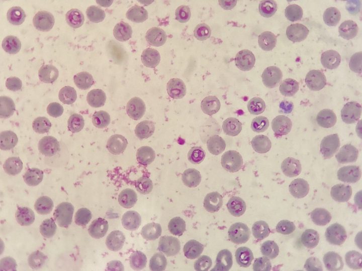Blood smear, high parasitemia with multiple plasmodium rings