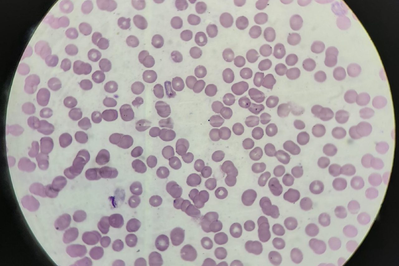Malaria Parasites in Blood Smears and Thick Blood Films