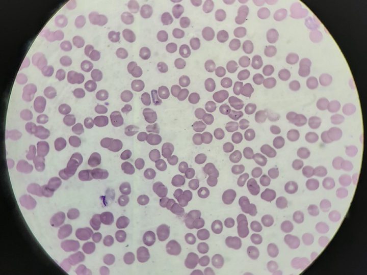 Blood smear, erythrocytes with ring-form Plasmodium trophozoites