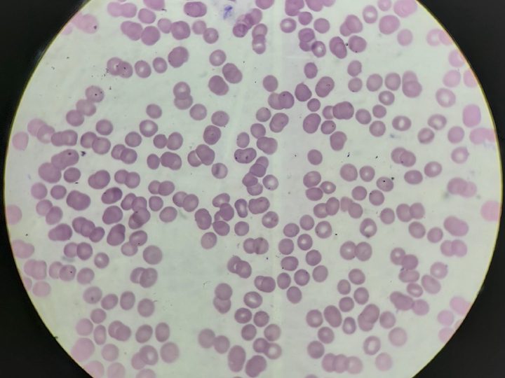 Blood smear, thin smear with intraerythrocytic parasites