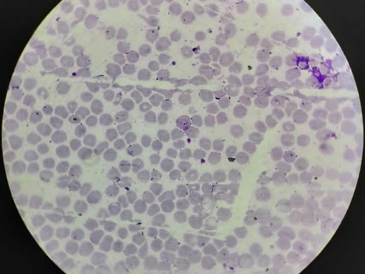 Blood smear, enlarged erythrocyte with growing Plasmodium trophozoite