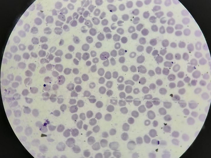 Blood smear, amoeboid Plasmodium trophozoite in the center of the field of view