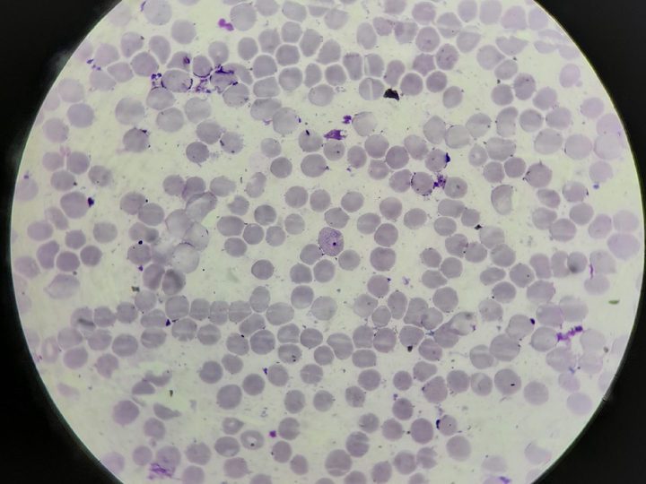 Blood smear, erythrocyte with developing malarial Plasmodium schizont