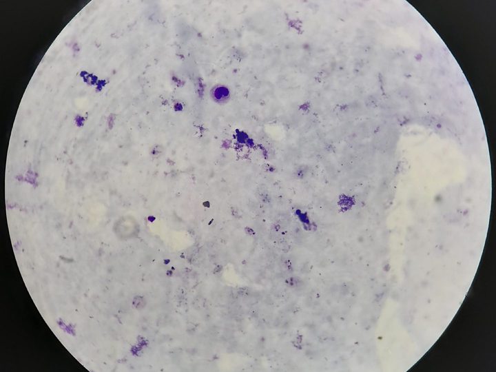 Thick blood film, overview field of view with a leukocyte