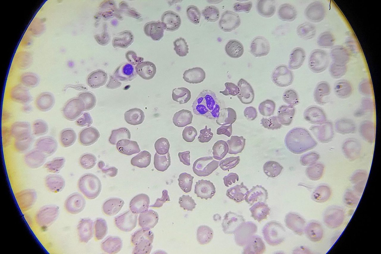Blood Smear in Beta-Thalassemia Post-Splenectomy