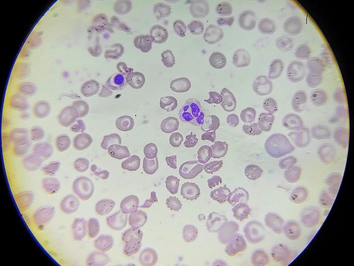 Blood smear: severe poikilocytosis, target cells, and a normoblast