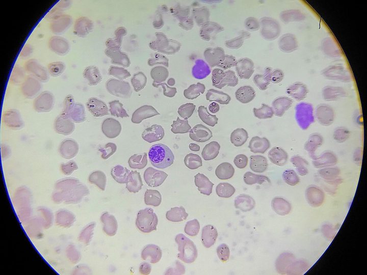 Blood smear: severe poikilocytosis, cell fragments, and a normoblast in the center