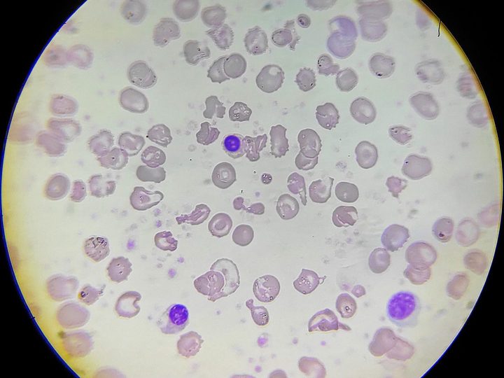 Blood smear: basophilic normoblasts against a background of severe anisopoikilocytosis