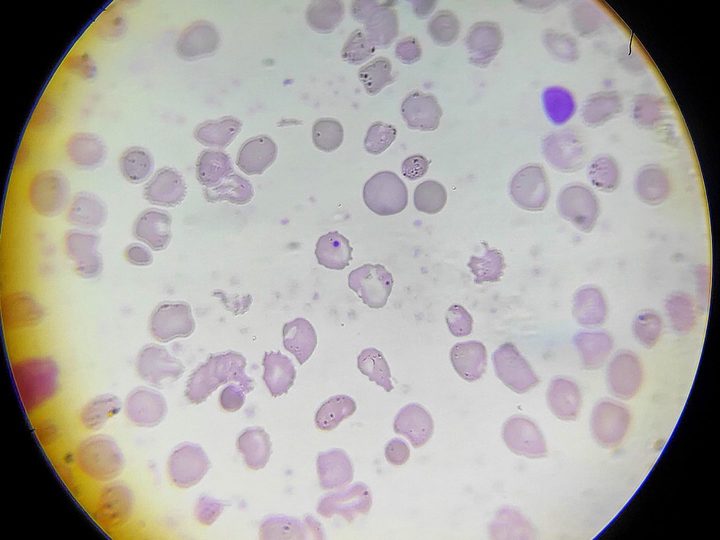 Blood smear: basophilic inclusions and Howell-Jolly bodies after splenectomy