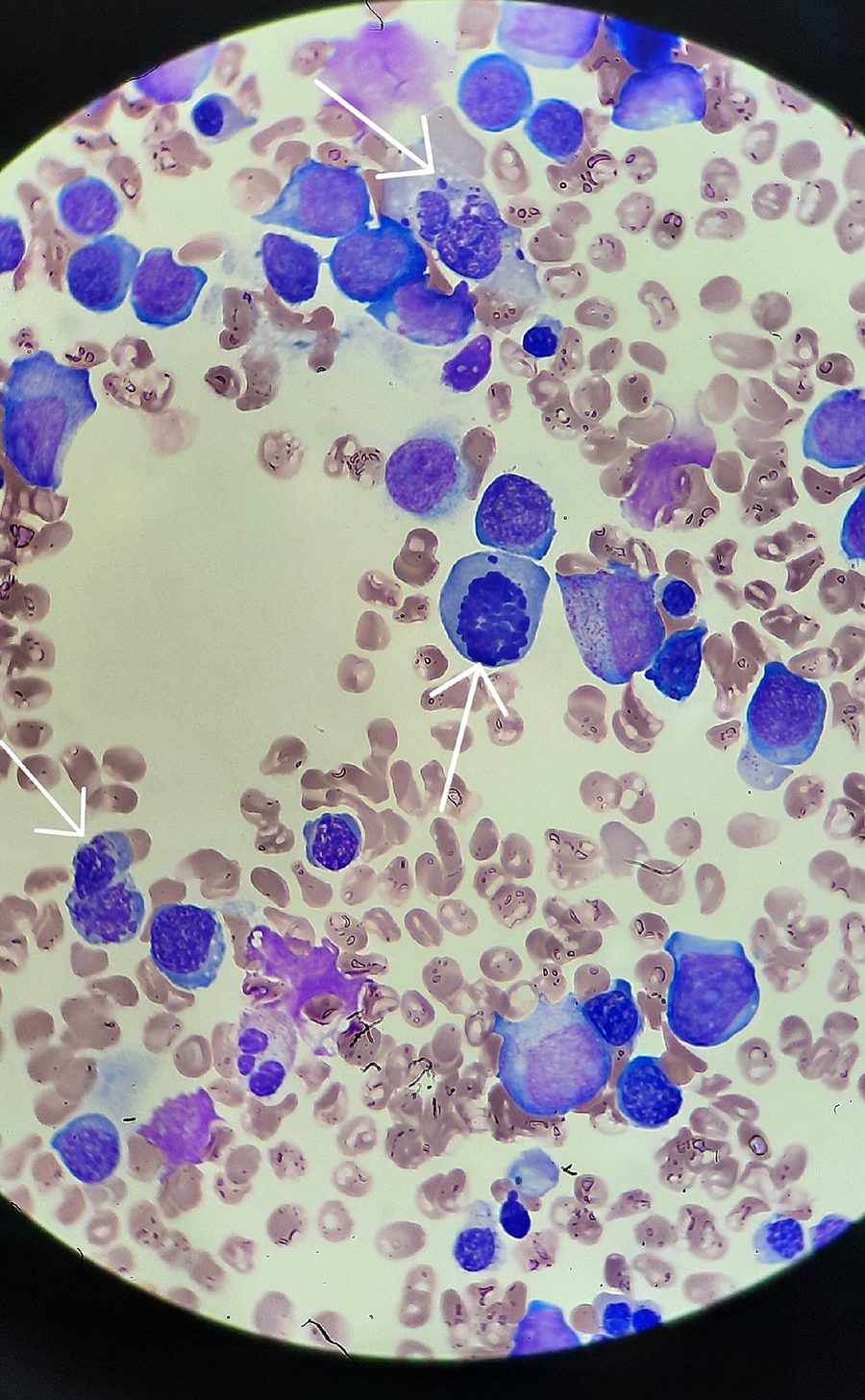 MDS with Erythroid Dysplasia of the Bone Marrow