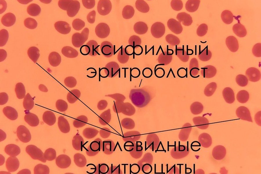 Мегакариоцит в крови при первичном миелофиброзе