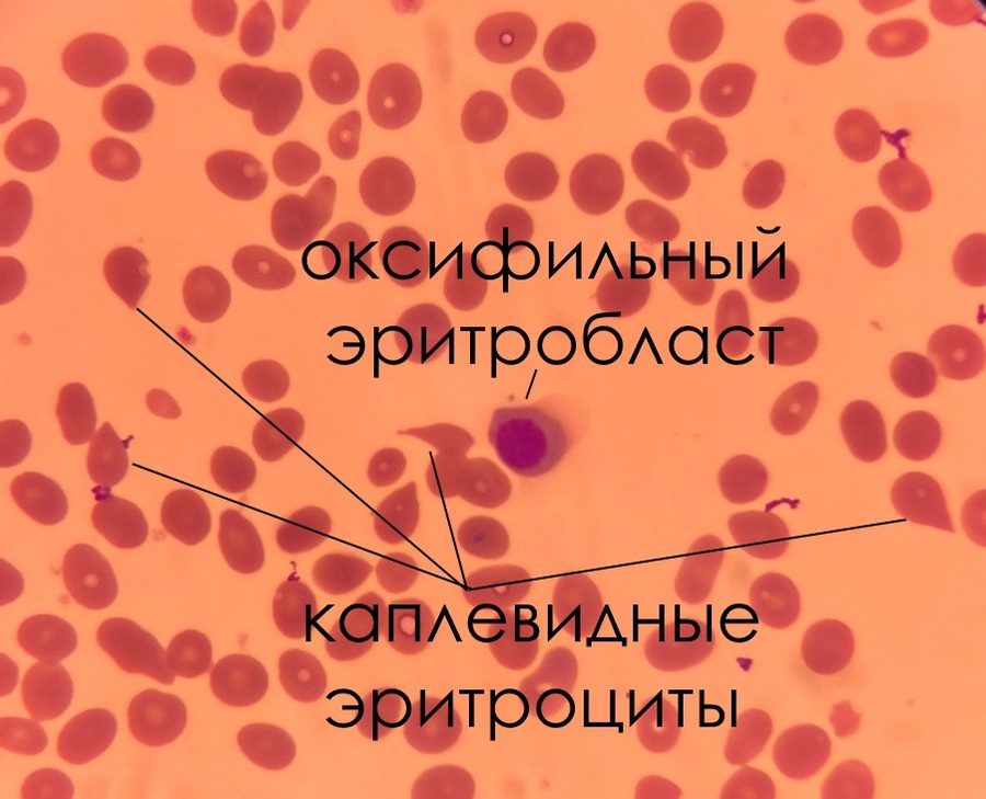Megakaryocyte in Blood in Primary Myelofibrosis
