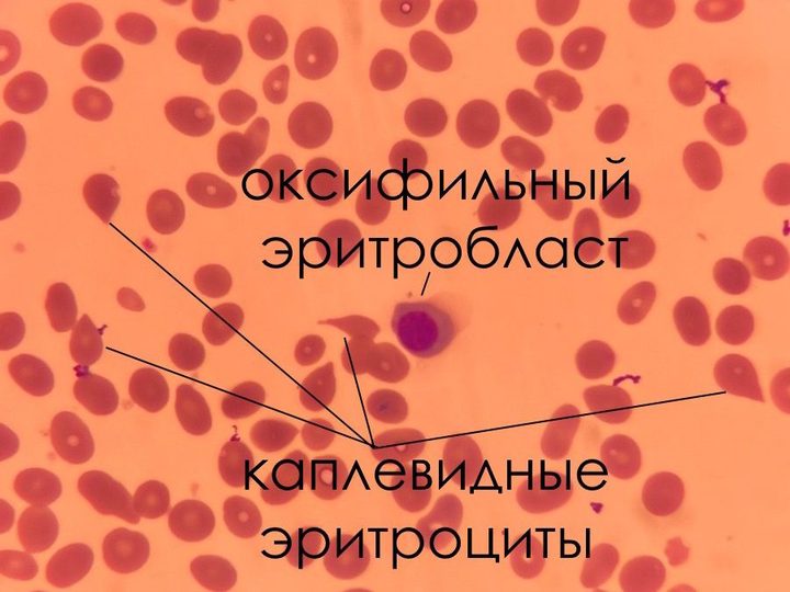 Мазок крови: оксифильный нормобласт и пойкилоцитоз с каплевидными эритроцитами