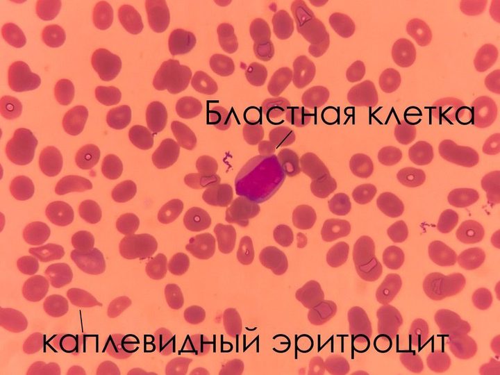 Мазок крови: бластная клетка и выраженный анизопойкилоцитоз