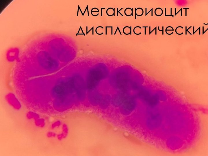 Мазок крови: гигантский диспластический мегакариоцит в поле зрения