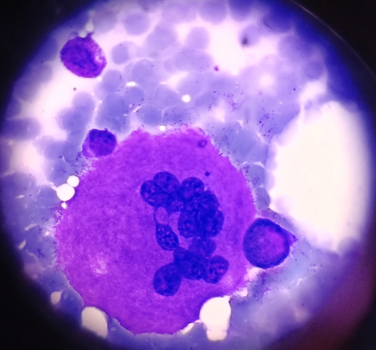 Megakaryocytes Without Platelet Budding in Bone Marrow