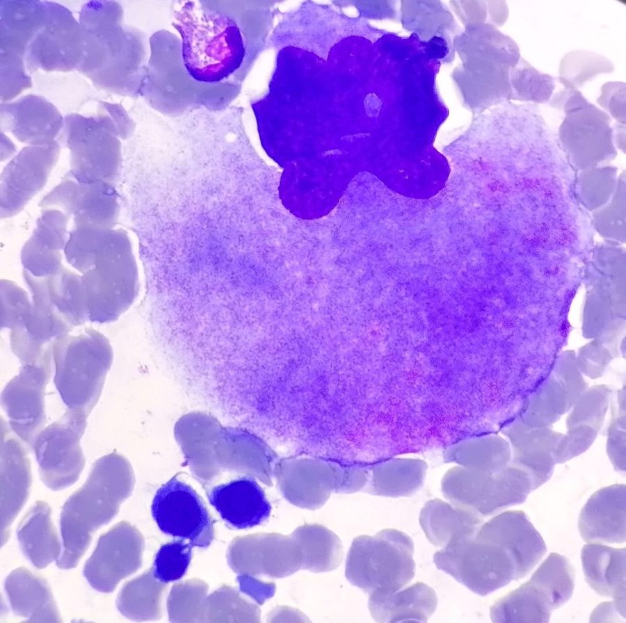 Megakaryocytes in Bone Marrow Aspirate and Thrombopoiesis