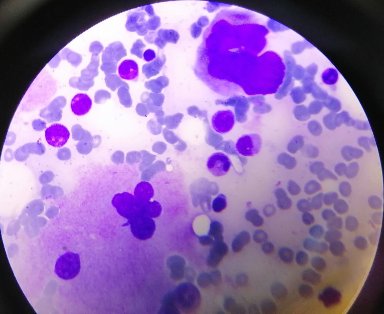 Megakaryocytes in Bone Marrow in Multiple Myeloma