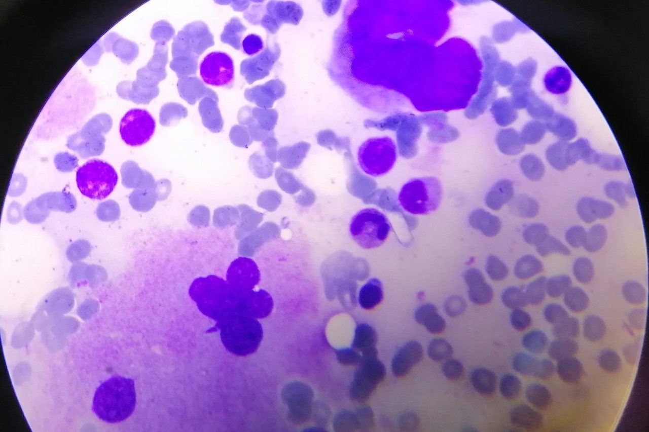 Megakaryocytes in Bone Marrow in Multiple Myeloma