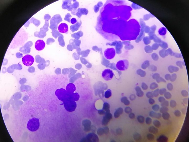 Bone marrow smear: mature megakaryocytes with lobulated nuclei