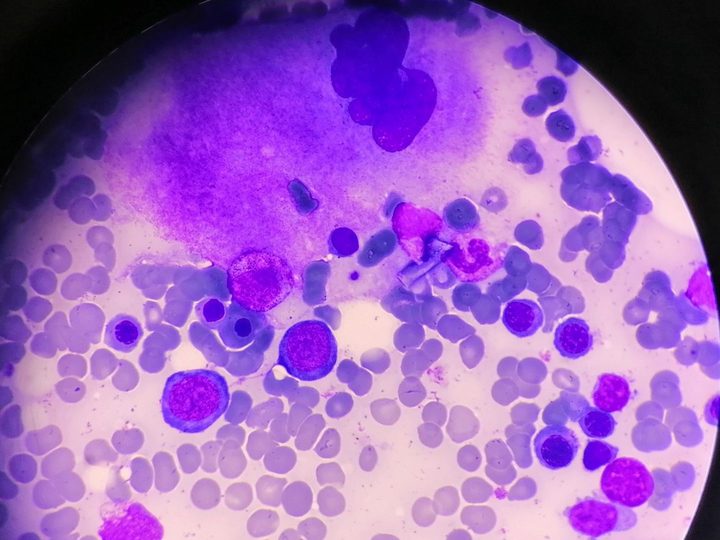 Bone marrow smear: large mature megakaryocyte with abundant basophilic cytoplasm