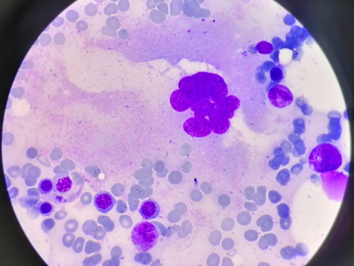 Bone marrow smear: megakaryocyte with hyperlobulated nucleus and granulopoietic cells