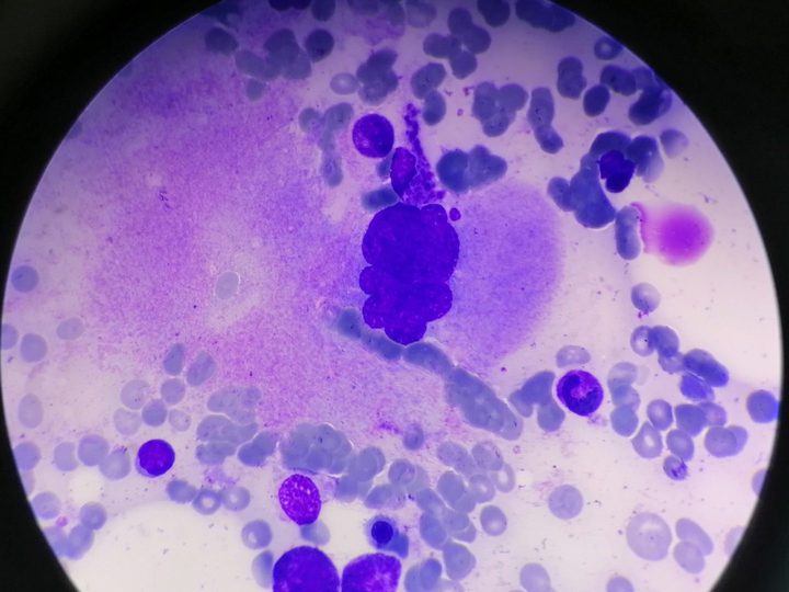 Bone marrow smear: mature megakaryocyte in the myelogram field of view