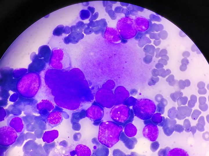 Bone marrow smear: megakaryocyte surrounded by granulocytic lineage cells