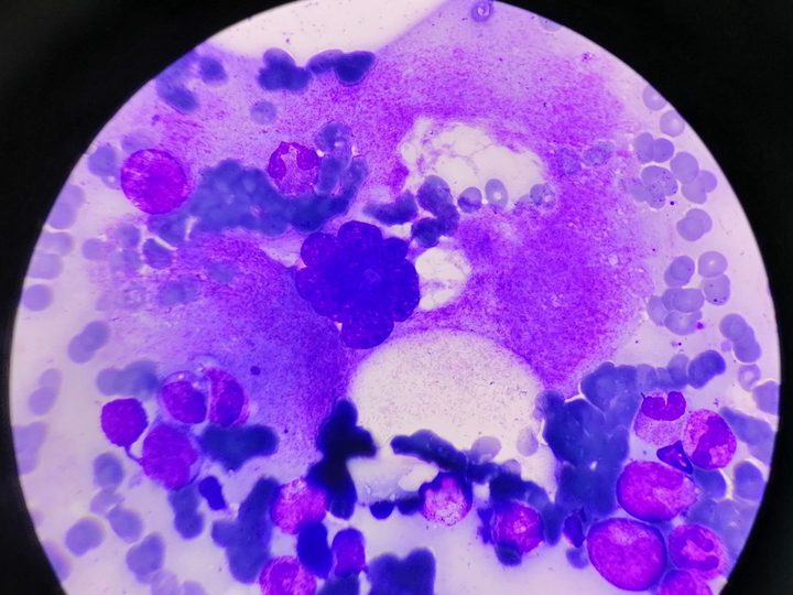 Bone marrow smear: large megakaryocyte with signs of platelet formation