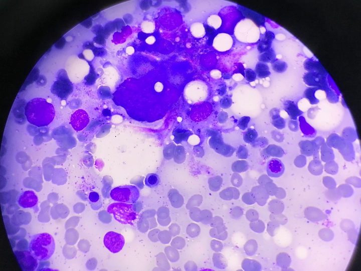 Bone marrow smear: polyploid megakaryocyte among bone marrow elements