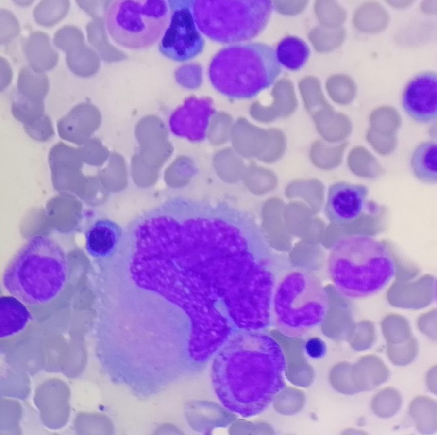 Megakaryocytes in Bone Marrow in Thrombocytopenia