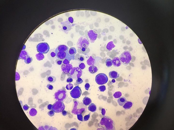 Мазок костного мозга: полихроматофильные и оксифильные мегалобласты