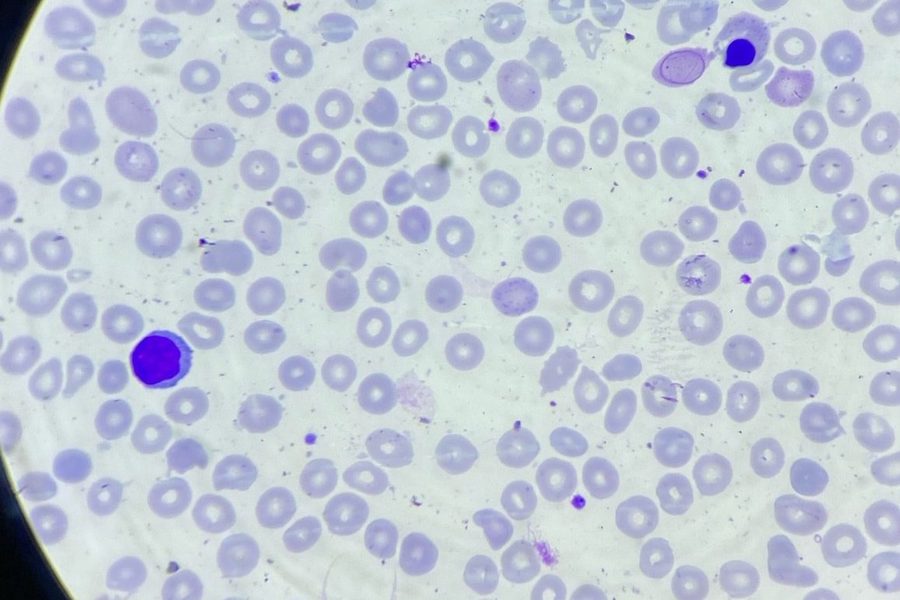Megaloblastic Anemia in a Child: Cabot Rings in Blood Smear
