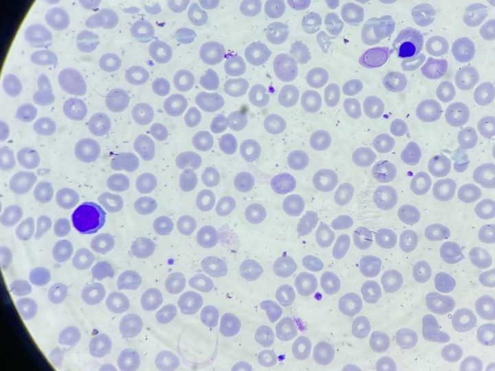 Blood smear: normoblast, macrocytes, and pronounced anisocytosis
