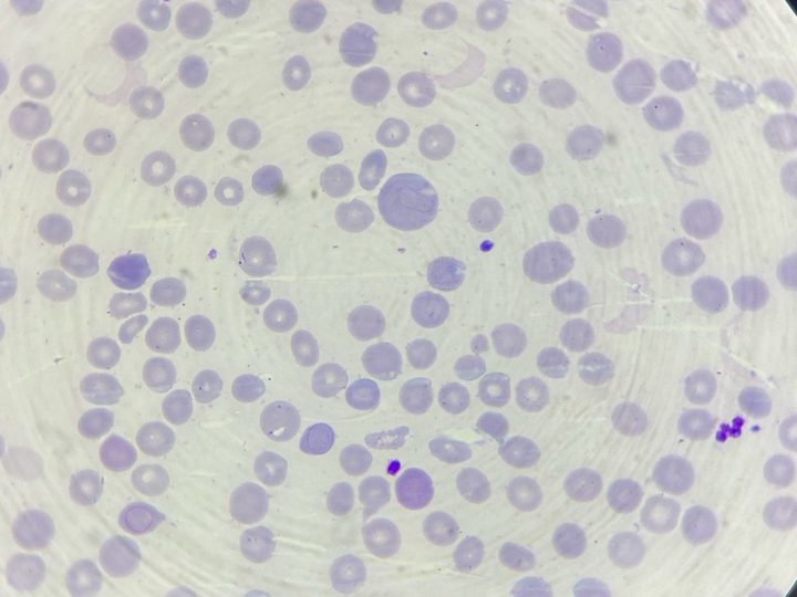 Blood smear: erythrocyte with a Cabot ring in an oval shape