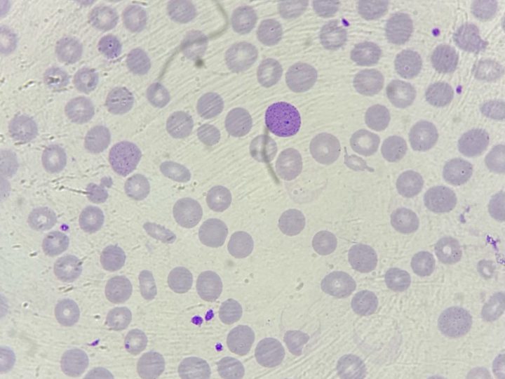 Blood smear: basophilic granularity of an erythrocyte close-up